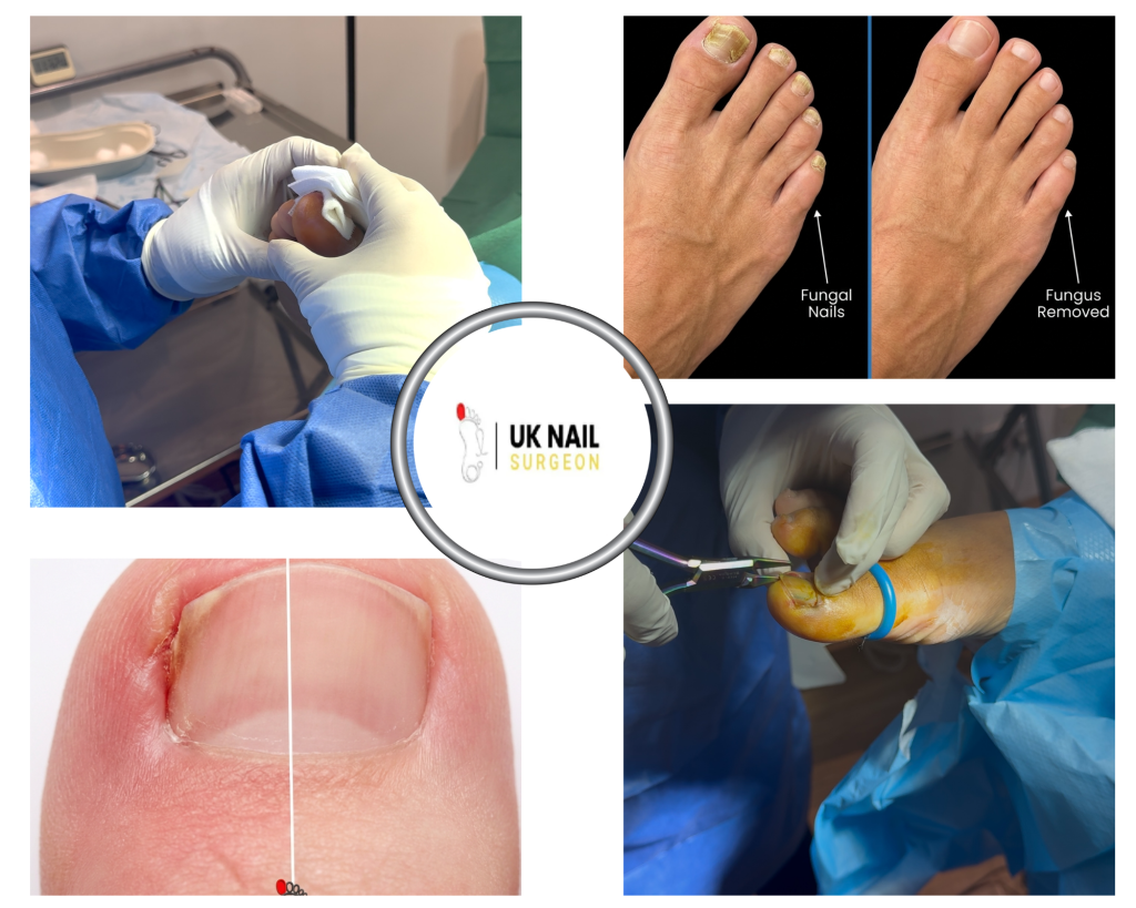 Relief and Recovery: A Practical Guide to Foot Nail Procedures