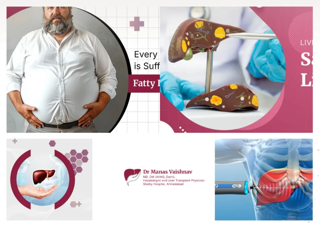 Top Liver Cirrhosis Specialist in Ahmedabad for Expert Diagnosis and Treatment